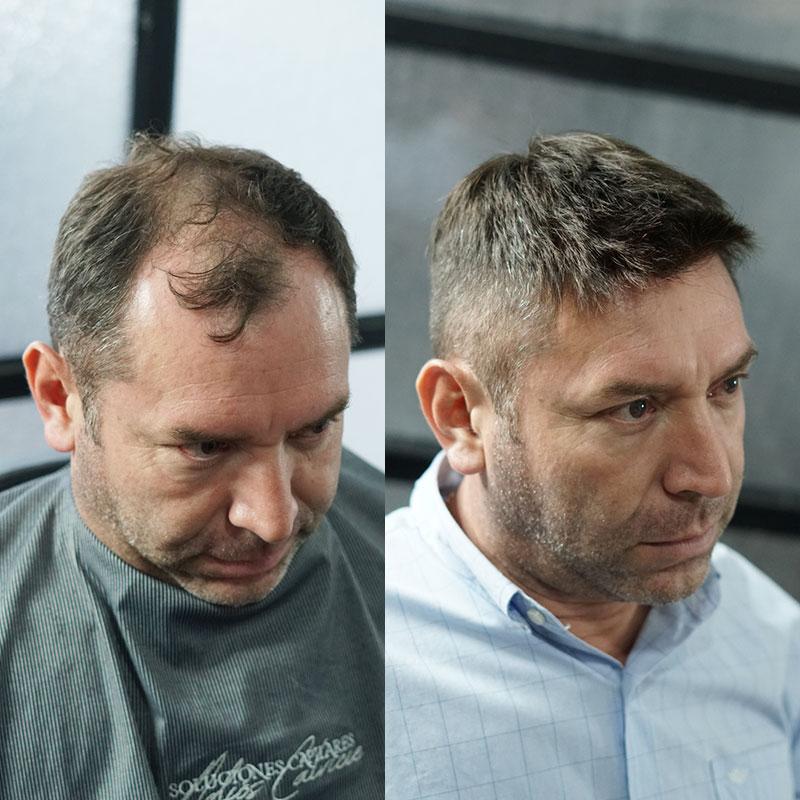 Hair System Before After Image