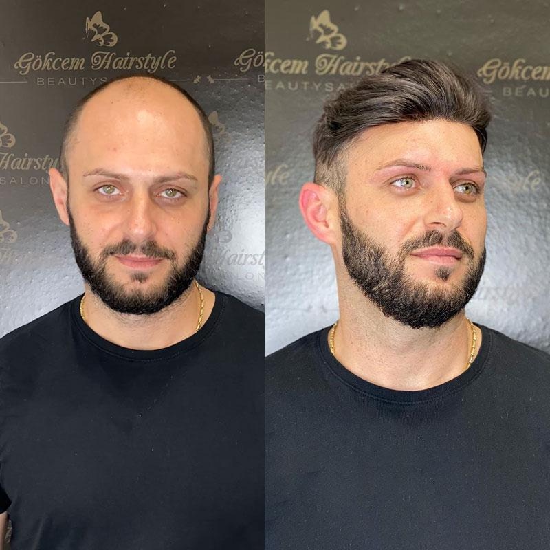 Hair System Before After Image