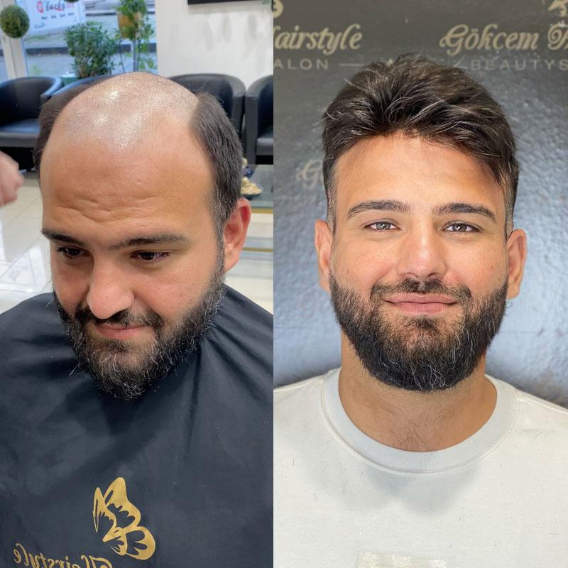 Hair System Before After Image