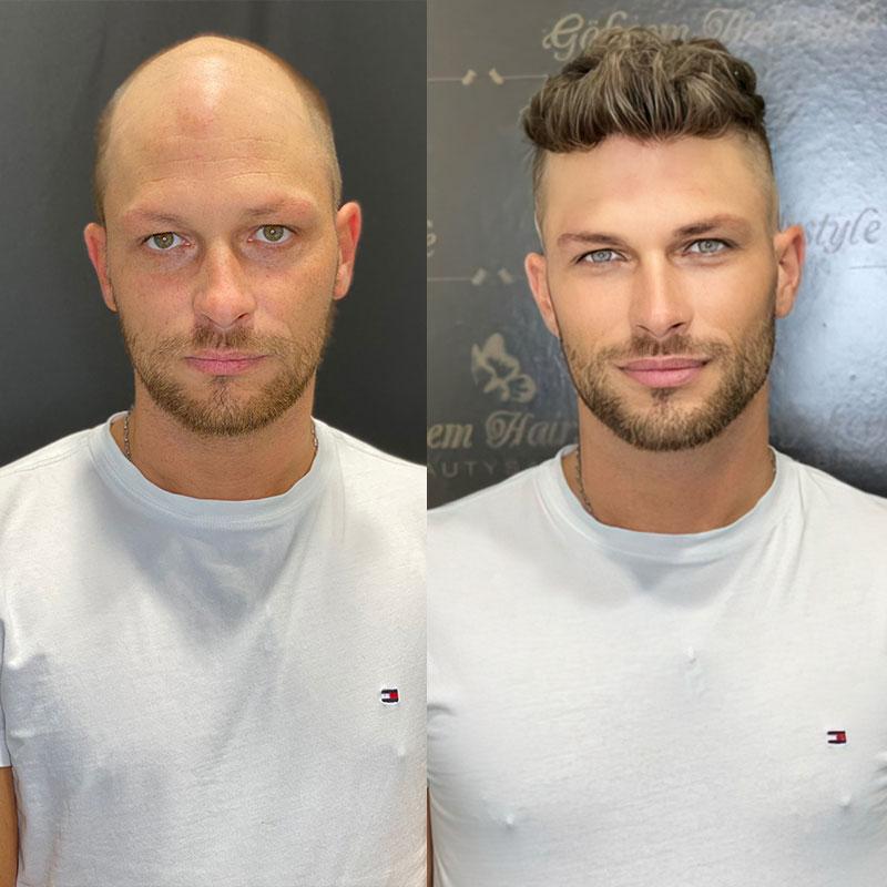 Hair System Before After Image