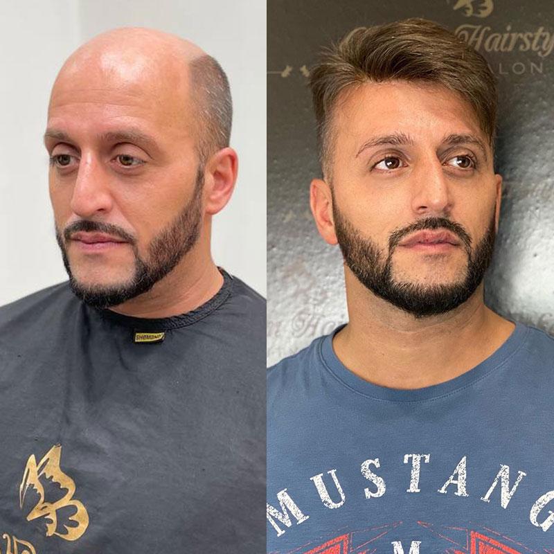 Hair System Before After Image