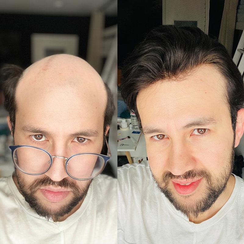 Hair System Before After Image