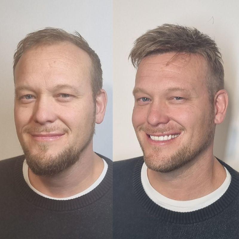 Hair System Before After Image