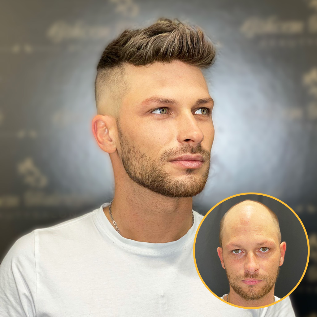 Full Swiss Lace Hair System Realistic Hairline | OFF STANDARD