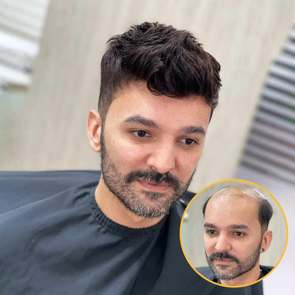 Men's Lace Hair System | OFF STANDARD