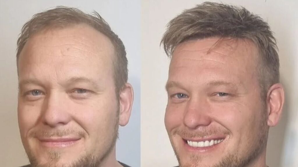 client's toupee before and after comparison