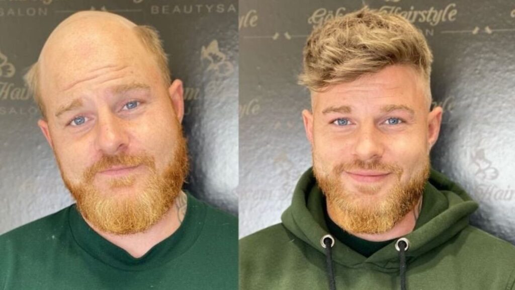 client's toupee before and after comparison 2
