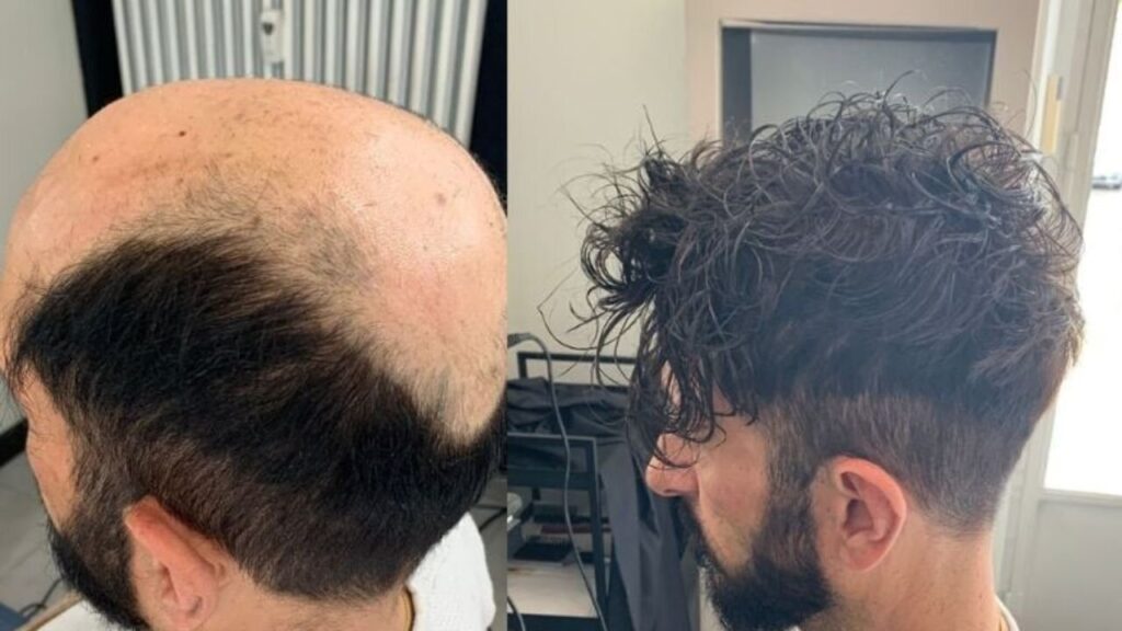 Client's toupee before and after comparison 3